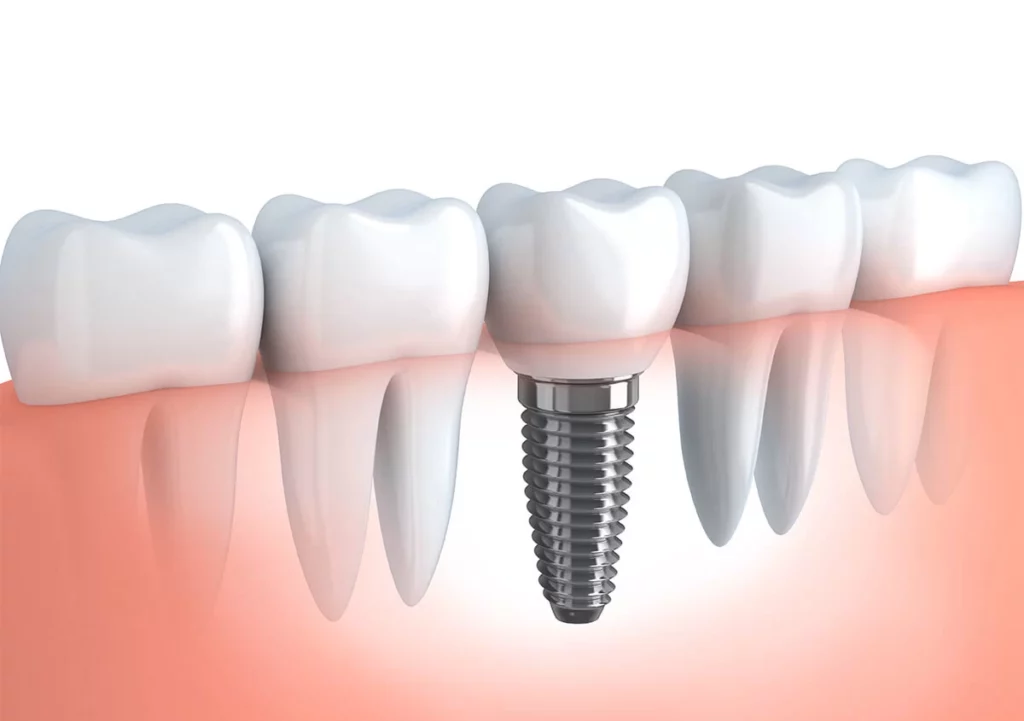 Dental implant illustration