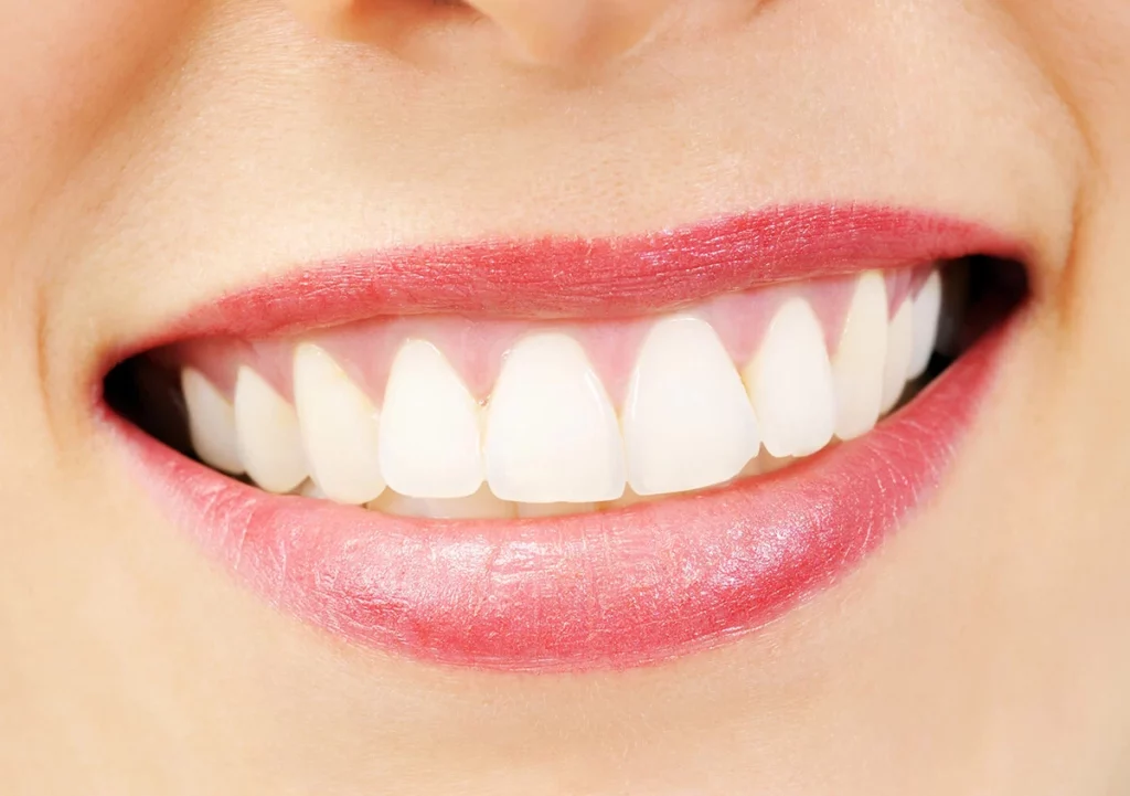 A bright smile representing dental veneers