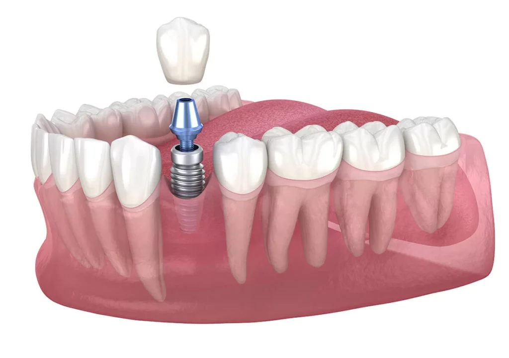 Illustration of an implant, abutment, and crown