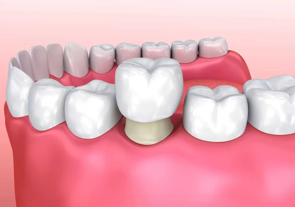 Dental crown being placed on a prepared tooth