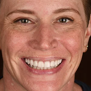 Smile shown in Walden Dental's patient gallery
